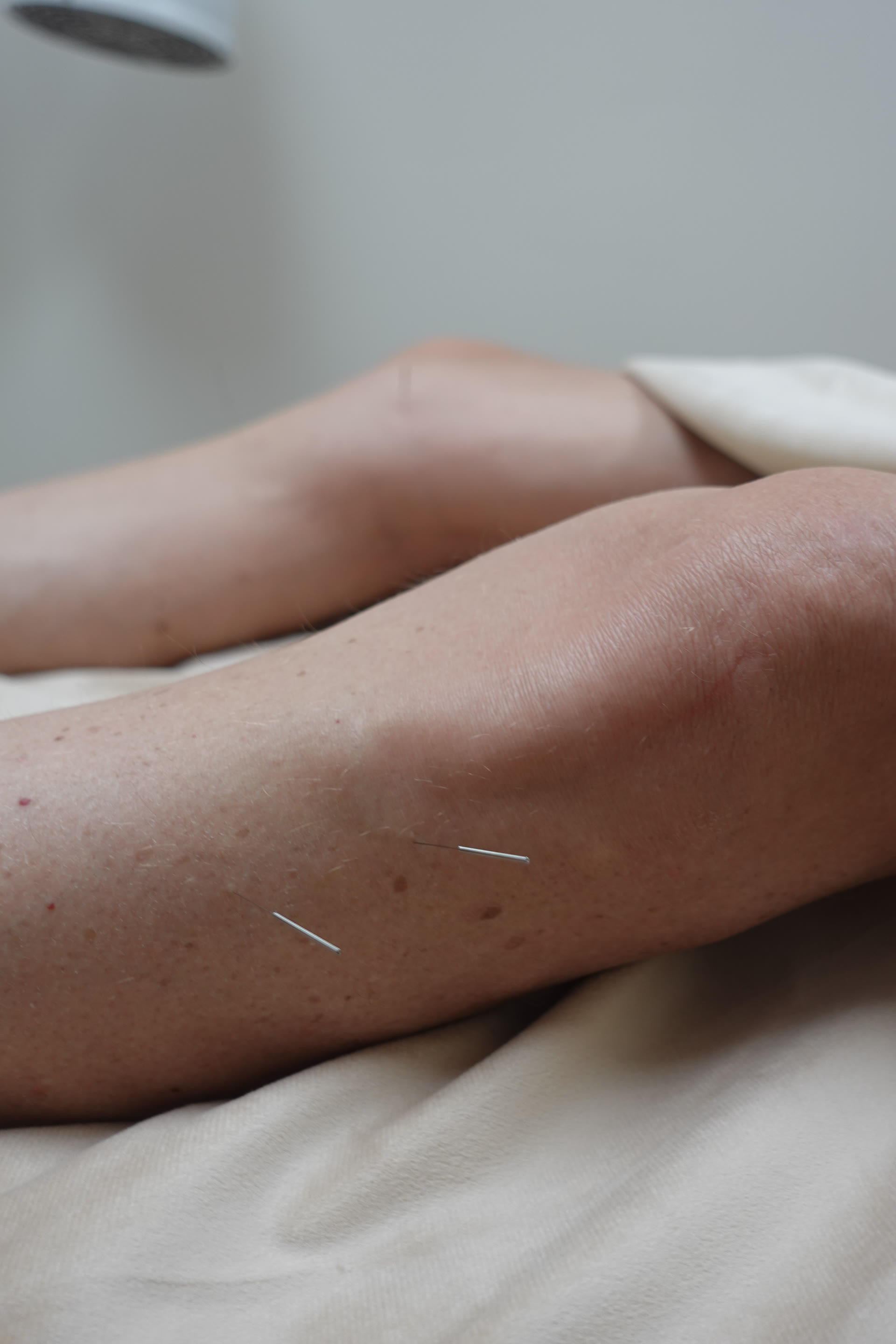 Acupuncture needles on the arm