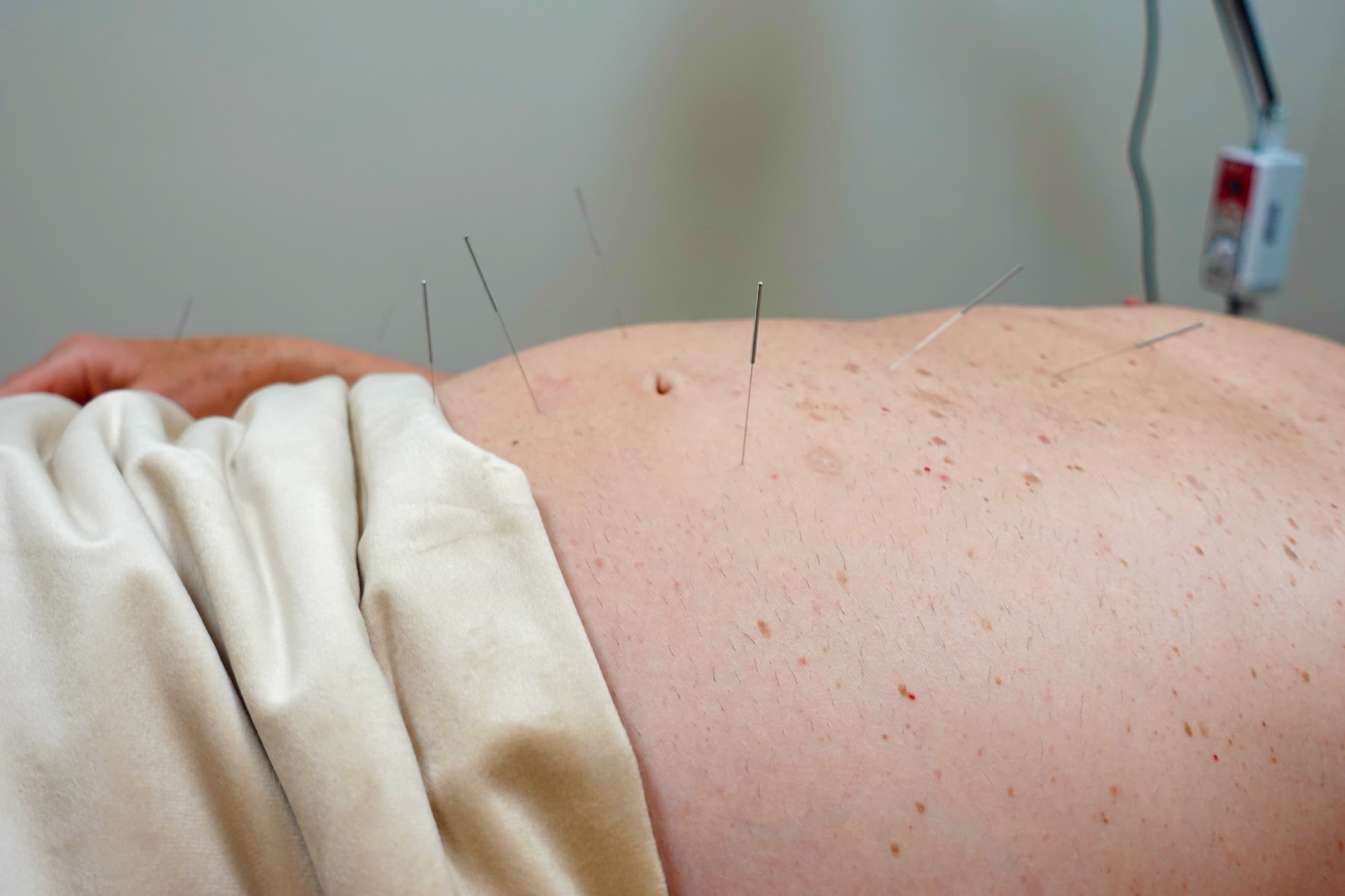 Acupuncture needles placed along the back
